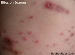Maybe you would like to learn more about one of these? Mite Bites