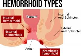 In most cases they can become strangulated and cause extreme pain. How To Treat Your Painful Hemorrhoids Naturally For Fast Relief Island Healthworks Blog