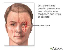 Dependiendo de la gravedad de la hemorragia, el. Aneurisma Cerebral