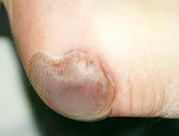 Definition • full thickness tissue loss in which actual depth of the ulcer is completely obscured by slough (yellow, tan, gray, green, or brown) and/or eschar (tan, brown, or black) in the wound bed. Https Nhs Stopthepressure Co Uk Docs Pu Grading Chart Pdf