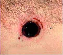 As with most unplated buckshot, some mild deformation of the shot was observed. Shotgun Injuries Gunshot Wounds Mussen Healthcare