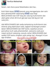 Satu alat bantu yang disebut selitan sepatu juga dirancang khusus untuk mendukung, meluruskan dan memperbaiki fungsi kaki anda. Cara Merawat Penyakit Kaki Tangan Dan Mulut Hfmd Dari Rumah