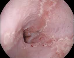 You are more likely to develop it if your immune system is weakened. Intractable Hiccups Due To Herpetic Esophagitis In An Immunocompromised Patient Sciencedirect