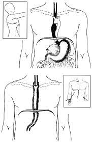 Mckeown esophagectomy is appropriate for all patients with siewert type i and ii patients, as well as all patients with tumor above the gastroesophageal junction, up to the level of the clavicle. Mckeown Esophagectomy Three Field Approach Medicine Nurse Thoracic