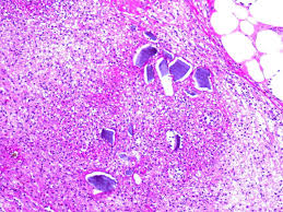 Image result for Kayexalate