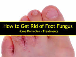 Apple cider vinegar, coconut oil and 3 other simple and effective remedies to treat toenail but if you notice toenail fungus when it has just started to grow, you can try to treat it with home combine a small amount of baking soda and borax (equal parts of both) with a little water to make a. How To Get Rid Of Foot Fungus Home Remedies Treatments