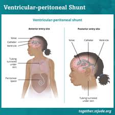 Doctors don't know why certain children develop a brain tumor. Brain And Spinal Cord Tumors In Children And Teens Together