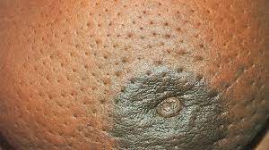 If you think you have mold growing on your body, you can try some of the. 7 Pictures Of Breast Cancer