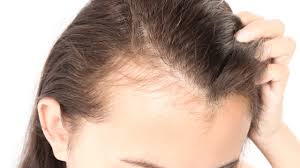 Diaten Hormone Stress Ist Haarausfall Bei Frauen Anders Bildplus Inhalt Gesundheit Bild De