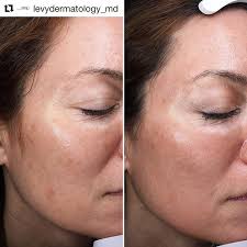 Halo hybrid fractional laser before and after. Halo Halobysciton Halo Laser Hybrid Fractional Laser