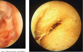 Image result for Acute Otitis Externa