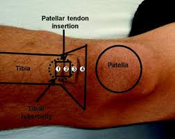 Hyperosmolar Dextrose Injection For Recalcitrant Osgood Schlatter Disease American Academy Of Pediatrics