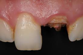 Immediate Provisional Restoration Of A Complete Crown Fracture