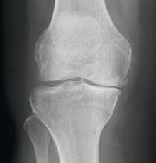 Maybe you would like to learn more about one of these? The Artificial Knee Joint Artiqo Endoprothetik