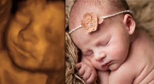 3D ultrasound images