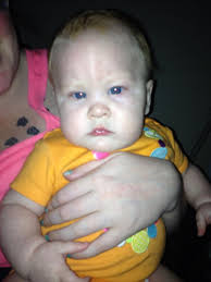 Renae's journey with Trigonocephaly Metopic Craniosynostosis.