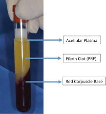 Acs petroleum research fund (acs prf) grants are intended as seed money, to enable an investigator to initiate a new since the first acs prf grants were approved in 1953, several grant. Platelet Rich Fibrin Utilization In The Treatment Of Periodontitis Intechopen