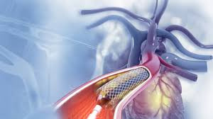Angiogram: ஆஞ்சியோகிராம் என்றால் என்ன? அது யாருக்கெல்லாம் எடுக்கப்படும்? எப்போது எடுக்க வேண்டும்? | What Is Angiogram And How It Is Done Explained In Detail | Asianet News Tamil