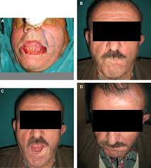 Find fujica flap gate to change the way you keep your building secure. Functional Reconstruction Of The Lower Lip With Fujimori Flap And Long Term Follow Up With Clinical And Electrophysiologic Evaluations Sciencedirect