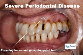 The split occurs on the multichannel tooth when periodontal infection penetrates into the area between and around the roots, which leads to the loss of alveolar process between the roots of teeth. Your Ultimate Guide To Periodontal Disease Periodontitis