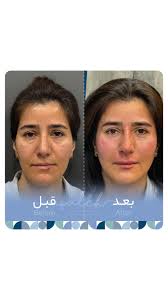 تزریق فیلر با حجم مناسب برای تناسب چهره و جبران کاهش حجم پدهای چربی ،بصورت  بسیار طبیعی چهره شما را زیباتر،متناسب تر و جوان تر می کند و به هیچ وجه ظاهر  مصنوعی و غیرطبیعی ایجاد نمی کند.., ...