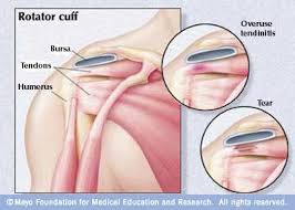 Types Of Rotator Cuff Injuries Rotator Cuff Injury Torn Rotator Cuff Symptoms Rotator Cuff