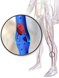 Coughing up blood is not the same as bleeding from the mouth, throat, or gastrointestinal tract. Vein Center Crystal Run Healthcare
