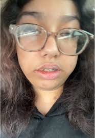 My tongue it gone hlep me #fyp #wisdomteethremoval #viral