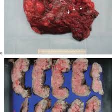 Pdf A Case Report And Literature Review Of Midtrimester Termination Of Pregnancy Complicated By Placenta Previa And Placenta Accreta