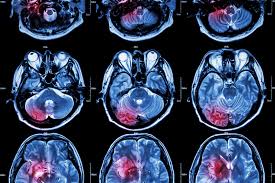 Brain Imaging after an Injury - Elizabeth Sandel, M.D.