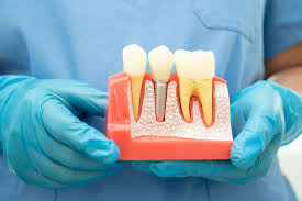 Dental Implants Balwyn - Dentist on Highfield Park