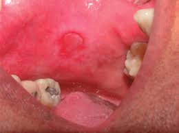 It is a persistent medical condition which affects the mucous membranes of the mouth and gives rise to papules, bilateral white striations. Erosive Lichen Planus On Jugal Mucosa Source Author S File Download Scientific Diagram