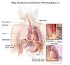 Image result for esophageal cancer silkworm