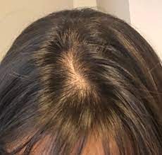 I know they're all new hairs because but the fact is, this baldness may be permanent. Bald Spot On Head From Postpartum Hair Loss November 2017 Babies Forums What To Expect