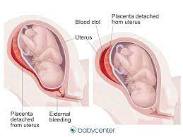 Round Ligament Pain | Babycenter