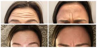 Therefore, as a single unit of botox goes much further in terms of dosage, the cost per treatment. Dysport Vs Botox All Your Questions About Dysport Answered According To Bbooks Becca Booker