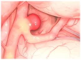 A brain aneurysm is an abnormal bulge or ballooning in the wall of an artery in the brain. What S A Brain Aneurysm Swedish Medical Center Seattle And Issaquah