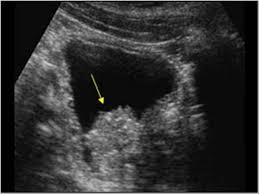 That is the genesis of the colors. Urinary Tract And Male Reproductive System 2 2 Bladder Case 2 2 1 Bladder Tumors Ultrasound Cases