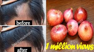 How can onion and garlic fight hair loss naturally? Grow Your Hair Faster With Onion Juice Stop Hair Fall With Home Remedy 100 Working Youtube