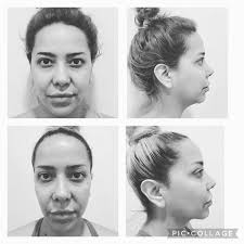 Neck/Chin Liposuction Albuquerque NM, D. Eric Tuggle, D.D.S.