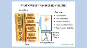Die medizinische terminologie ist ab sofort leicht verständlich. Transverse Myelitis And Occupational Therapy Theindependentbd Com