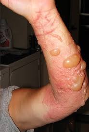 However, symptoms may form earlier depending on how sensitive the skin is. Poison Ivy Oak And Sumac Internachi