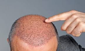 Factors including changes in nutritional status and the impact of surgery upon the. Hair Transplant In Turkey Best Doctor For Fue Hair Transplantion Haqqi Tours Haqqi Tours Travel Agency