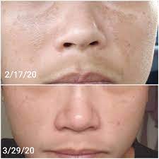 Check spelling or type a new query. The Spot Cream Reviews Musely Facerx Prescription Skincare