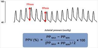 Image result for Pulse Pressure
