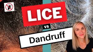 Image result for lice vs dandruff