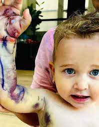 That's Outrageous!”: Parents Of 2YO Bitten By Rattlesnake Charged $300k For  Life-Saving Cure