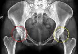 Image result for Hip Dislocation