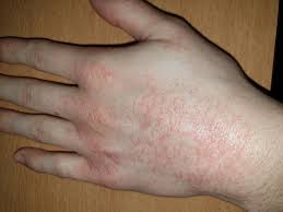 Moglicher Ausschlag Auf Hand Gesundheit Und Medizin