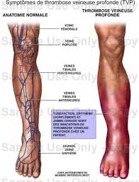 ➤ die thrombose entspricht einer blutgerinnung, die nicht beim kontakt mit der außenwelt, sondern innerhalb eines. Epingle Sur Cours Pathologies Veineuses